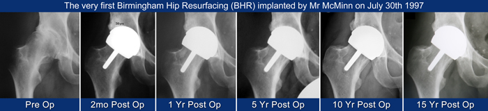 15 Year Birmingham Hip Resurfacing